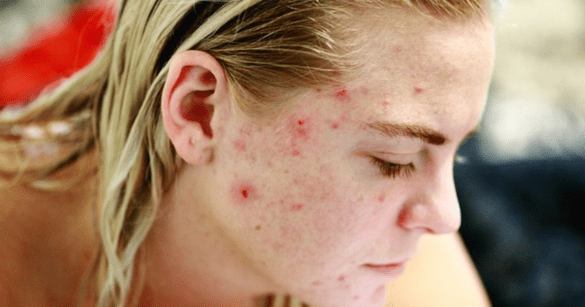 Acne Scars