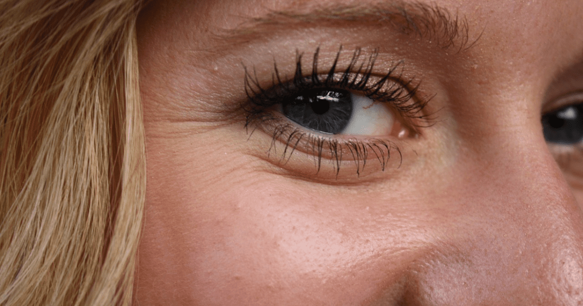 Dry Skin This image shows a girl's Dry Skin wrinkles