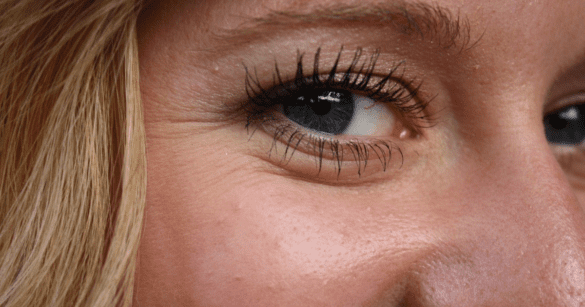 This image shows a girl's Dry Skin wrinkles